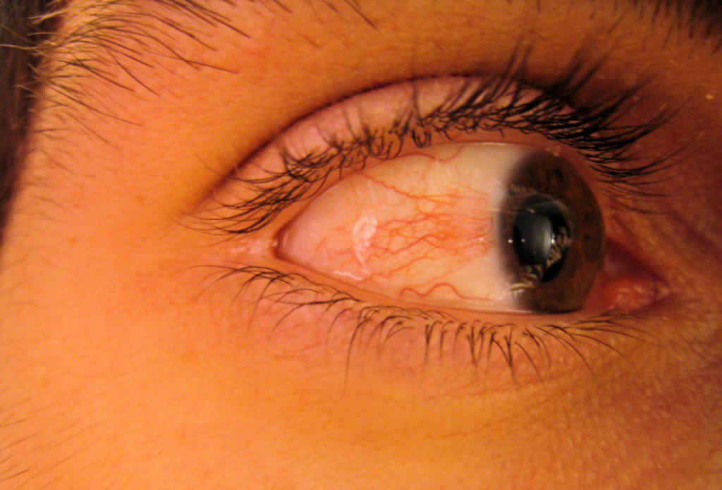 My red eye.. WTF